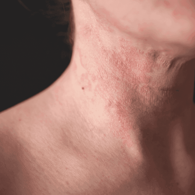 Dermatitis